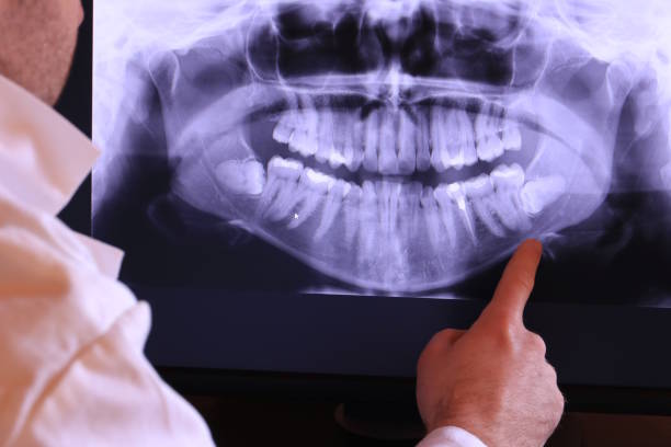 Best Emergency Dental Care for Broken or Chipped Teeth in Strawberry Point, IA